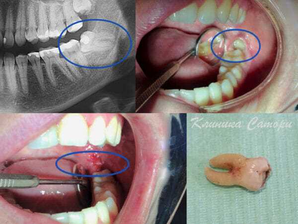 Важно знать — все об удалении верхнего зуба и последующей реабилитации