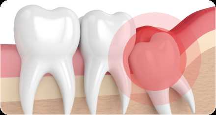 Как обеспечить успешное удаление вышедшего зуба?