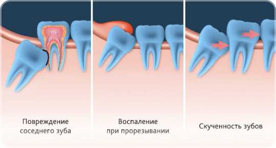 Когда удаление вышедшего зуба необходимо?