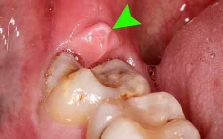 Удаление зачатка зуба