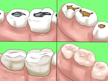 Виды операций на деснах в хирургии стоматологии