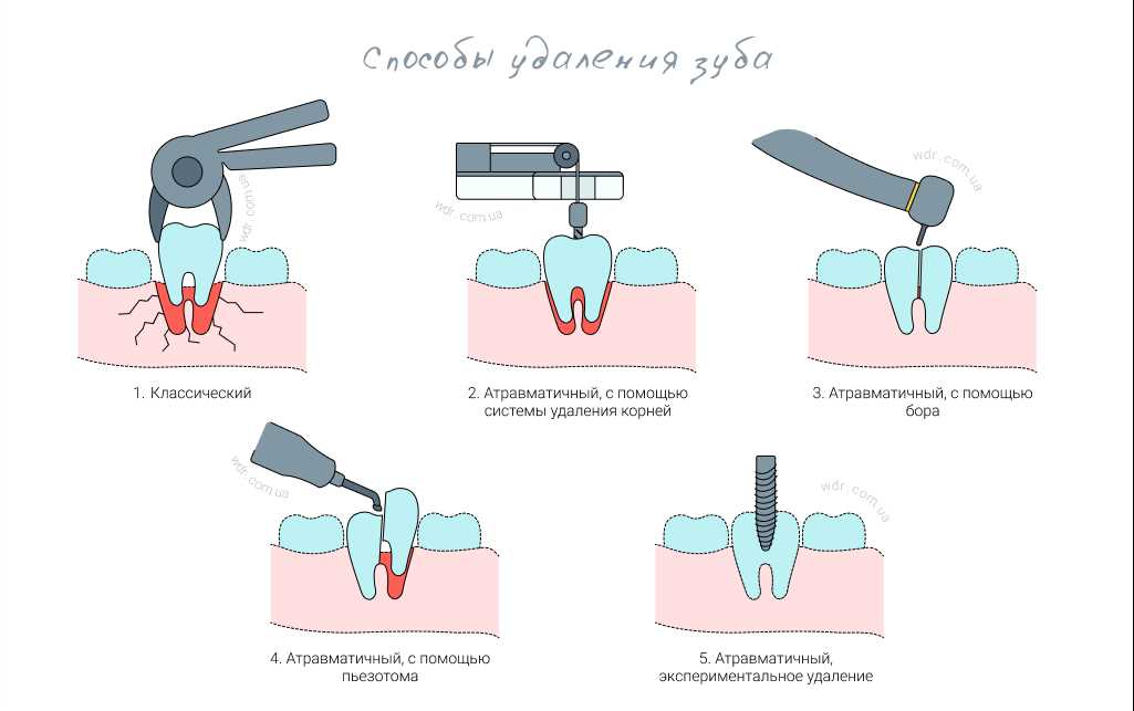 Удаление зуба 5