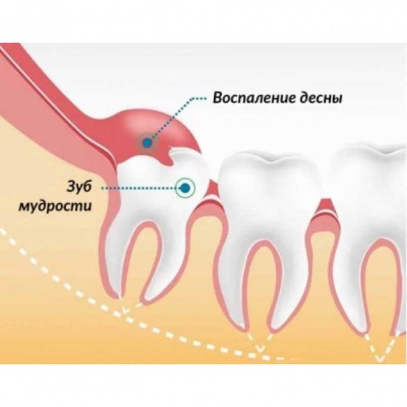 Может ли удаление зубов повлиять на результат анализов?