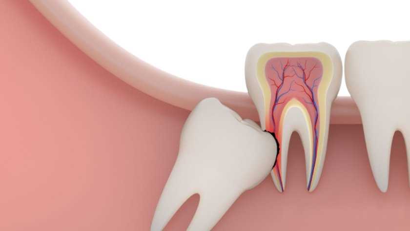 Как минимизировать боли и риски при удалении зуба в бане
