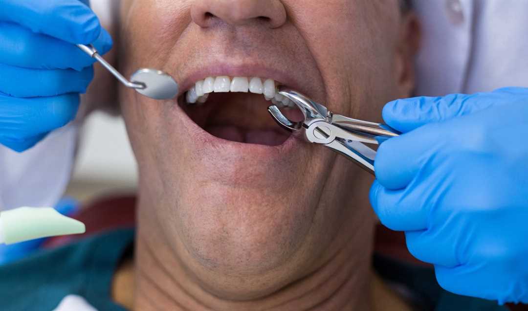 Памятка пациенту после удаления зуба
