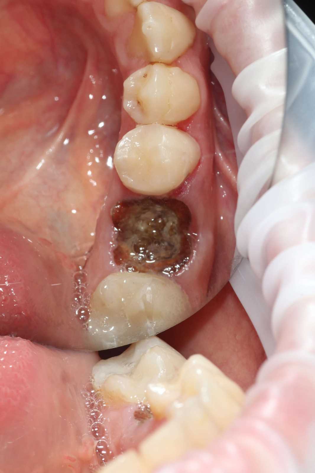 Удаление зуба безболезненно — все, что вам нужно знать о процедуре в бассейне