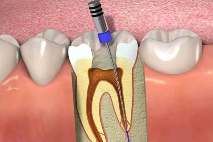 Удаление зуба без нерва