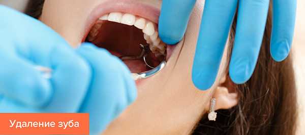 Рекомендации пациентам с гипертензией после операции удаления зуба