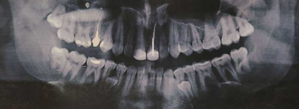 «История удаления семи зубов, включая два сверхкомплектных». Комментарии специалистов.