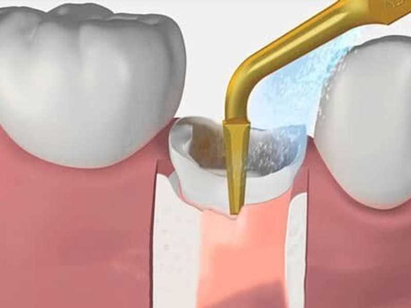 Удаление зуба и последующая имплантация