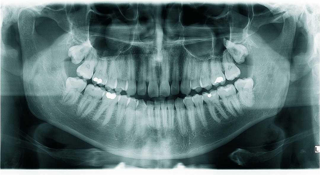 Показания к удалению зубов при кормлении