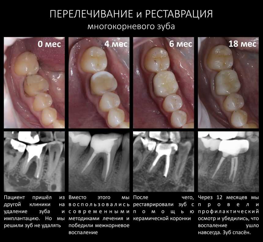 Удаление зуба кусочками