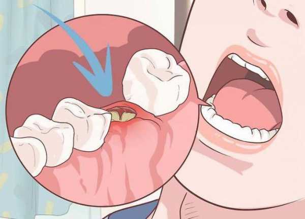 После удаления зуба образовался большой сгусток - это нормально?