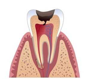 Можно ли избежать удаления нерва зуба?