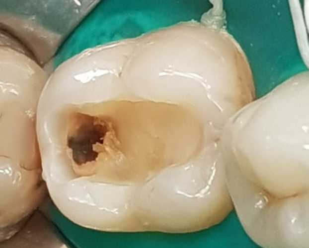Показания к использованию мышьяка в зубе