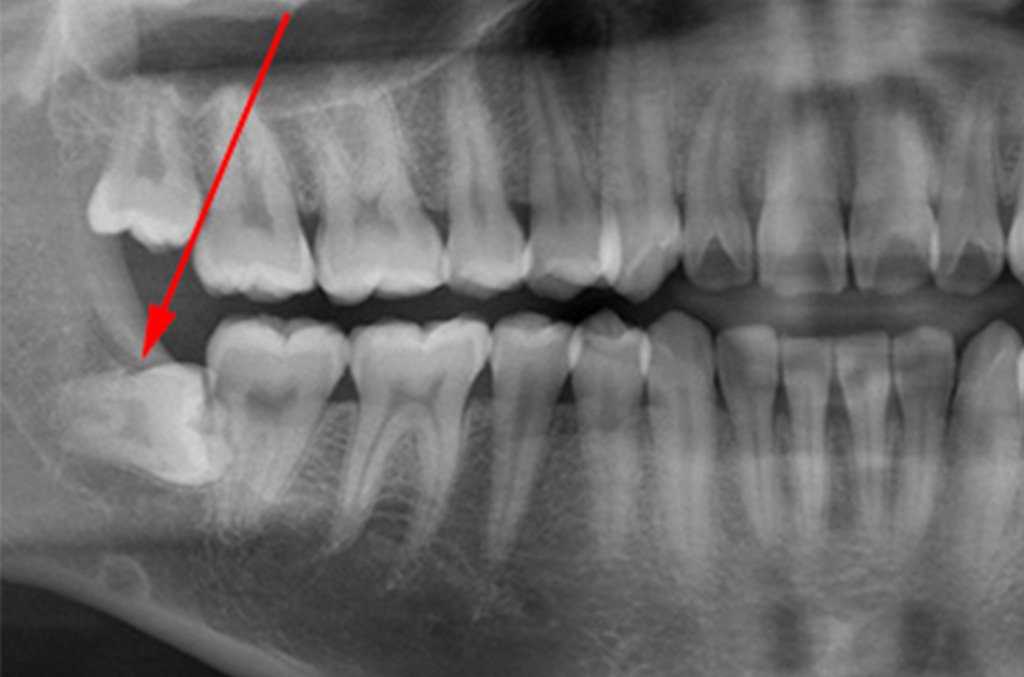 Удаление зуба — симптомы, причины, подготовка к операции, последствия и реабилитация