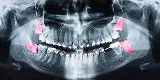 Удаления зубов мудрости под общим наркозом в стоматологии РуДента