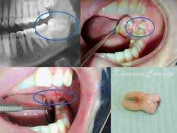 Как проходит операция по удалению зуба мудрости