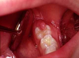 Будет ли так же больно удалять зуб, как в детстве?