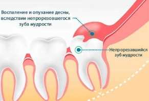 Удаление зуба над зубом