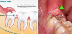 Воспаление надкостницы зуба – симптомы