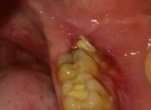 Воспаление надкостницы после удаления зуба: причины и методы лечения