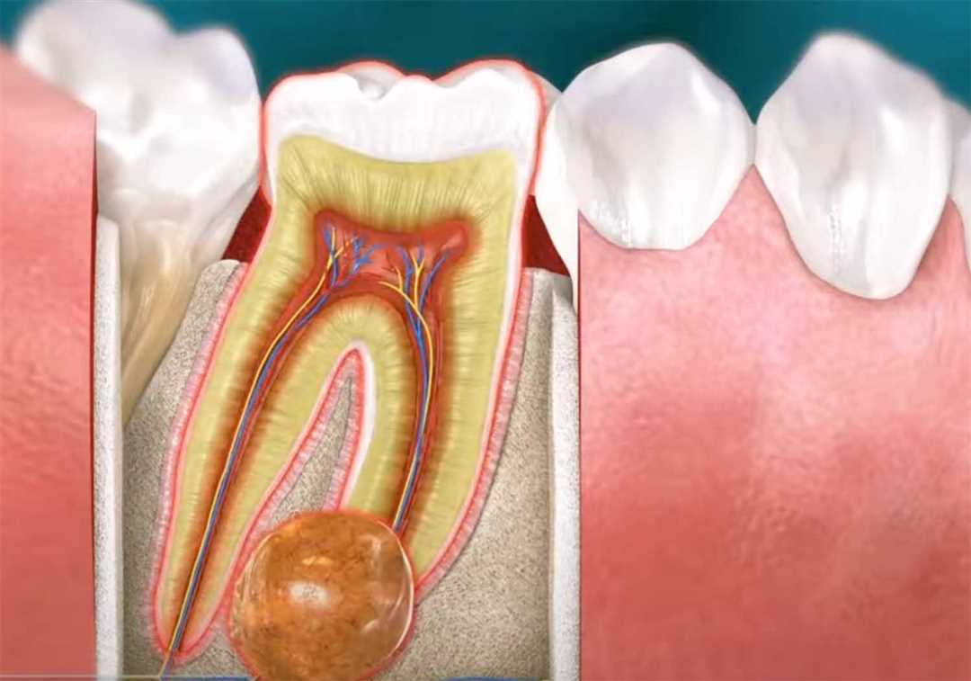 Чем лечить воспаление надкостницы зуба до визита к врачу?