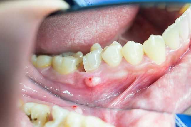 Удаление зуба надкостница
