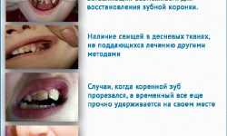 Основные принципы удаления молочных зубов дома