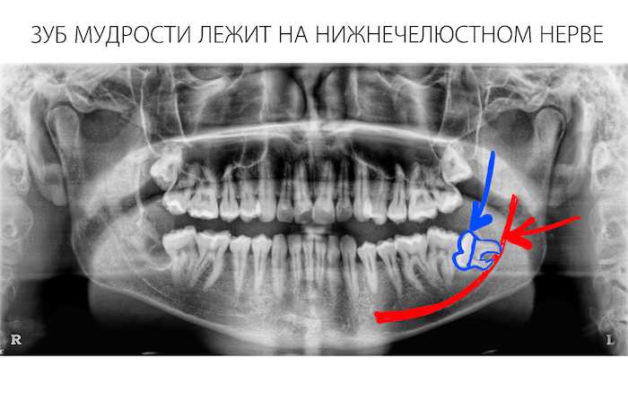 Удаление зуба пазуха
