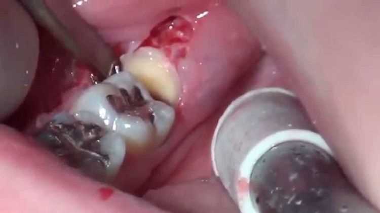 Сложное удаление зуба – когда и как проводится?