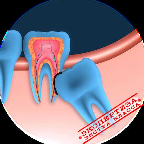 Удаление зуба беременной: описание процесса