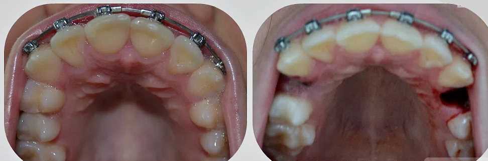 Можно ли и как избежать удаления зуба