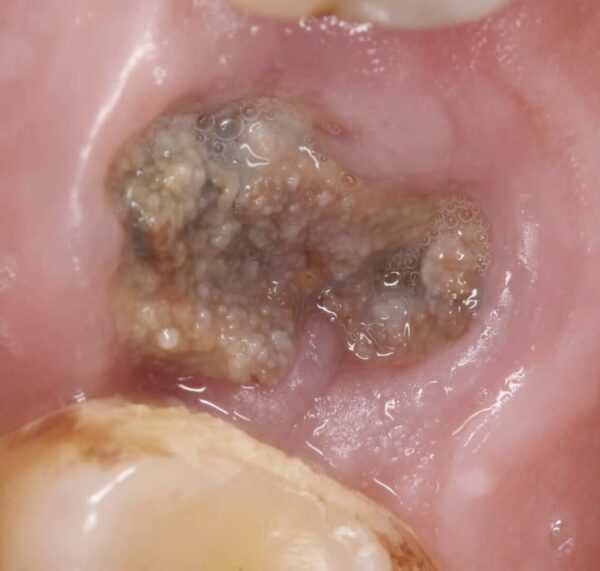 Методы удаления зуба при воспалении — что нужно знать и как происходит процедура