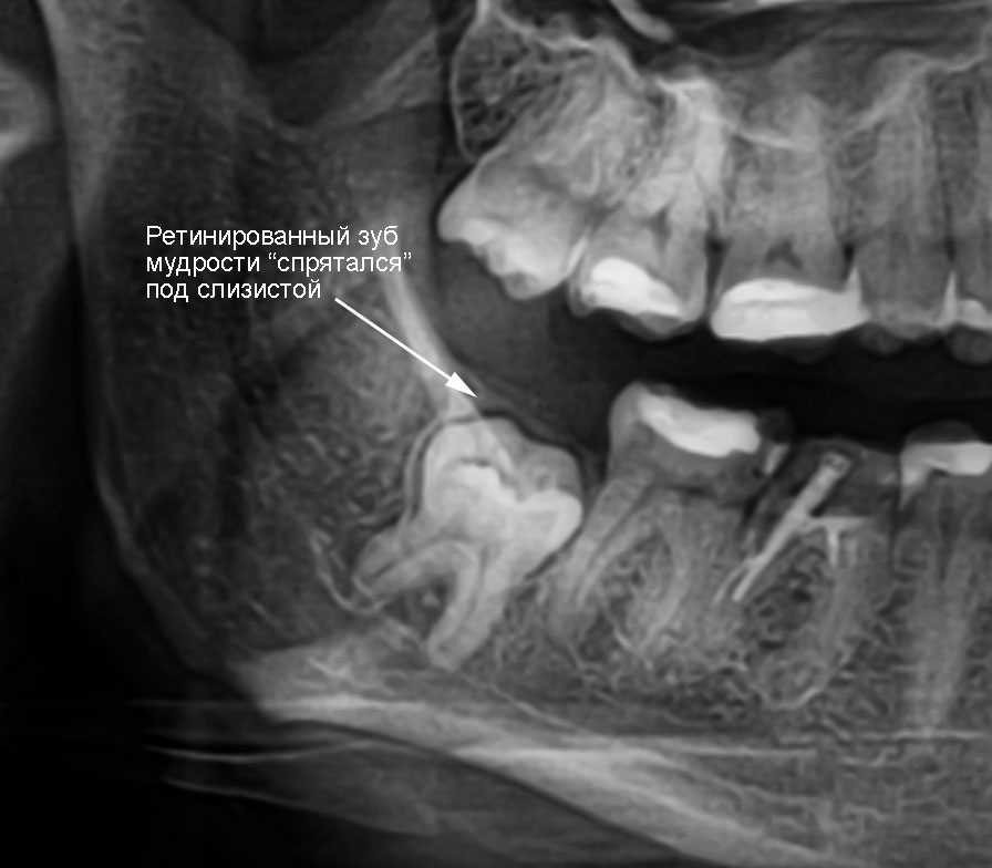 Удаление зуба рентген