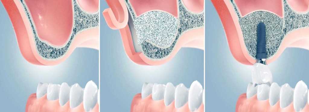 Как проводится лечение зубов под коронкой