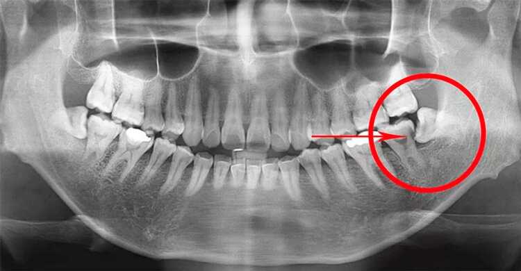По каким причинам необходимо удалять восьмые зубы снизу?