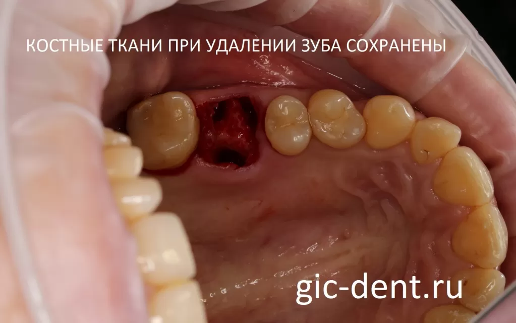 Удаление зуба снизу