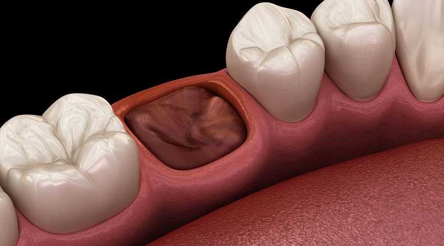 Удаление зуба тампон — как проходит процедура, какие есть сроки восстановления и как избежать осложнений