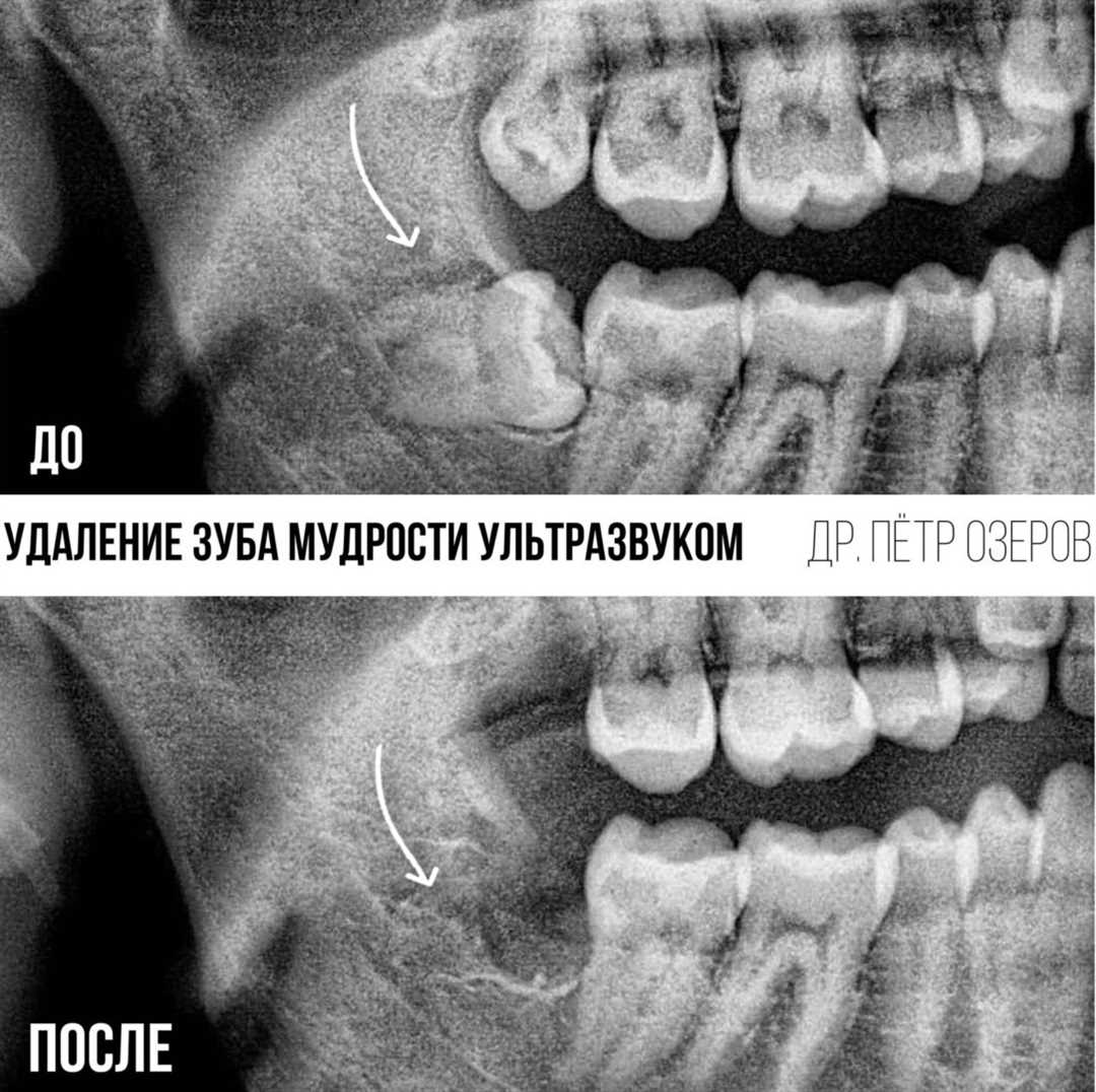 Шумовое удаление зуба с помощью ультразвука — эффективное и безопасное решение