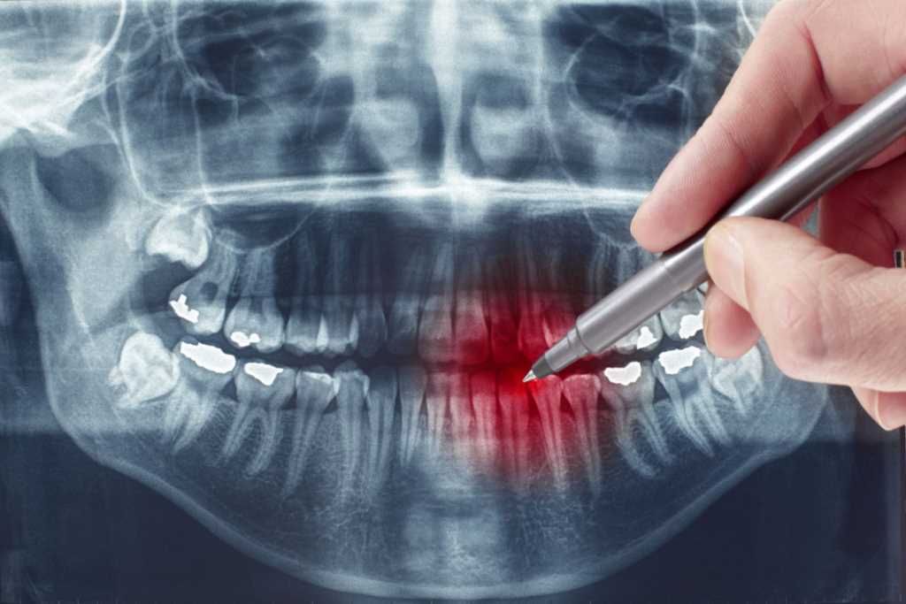 Почему удаление зуба может быть сложным?