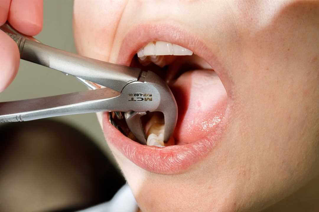Какой врач-стоматолог удаляет зубы