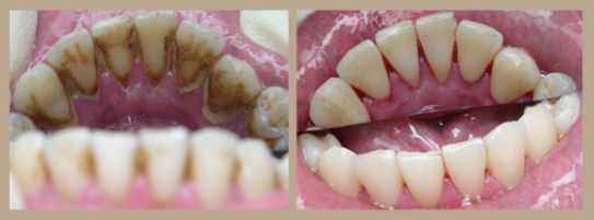 Ощущается ли боль или дискомфорт при удалении зубного камня?