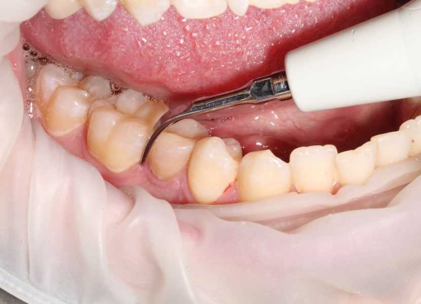 Как избежать образования зубного камня у детей