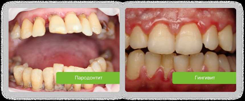 Как правильно и безопасно удалять зубной камень кюреткой — основные этапы и рекомендации