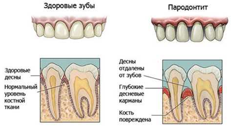 Опасности зубного камня и методы его удаления — сохраните здоровье полости рта