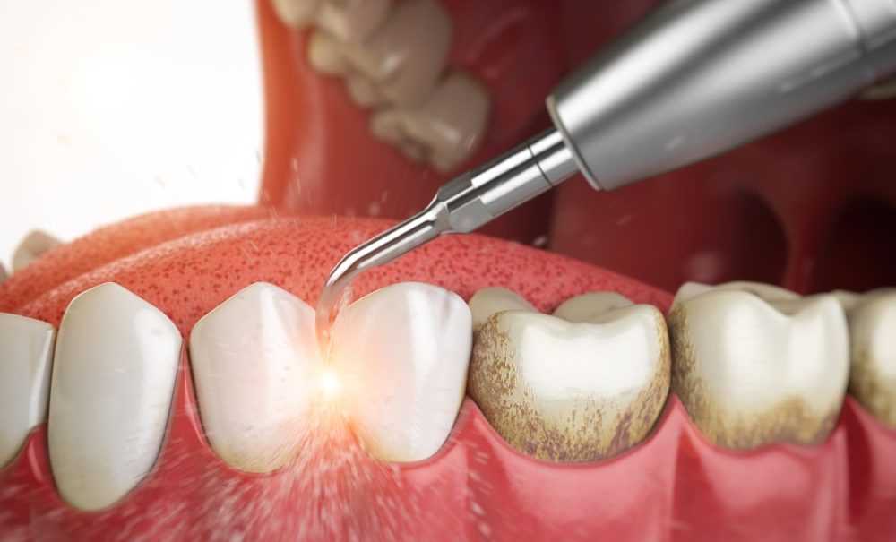 Каков процесс снятия зубного камня?