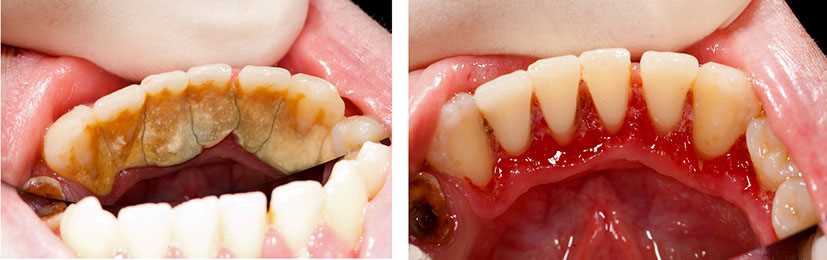 Как удаляют твердые отложения на зубах