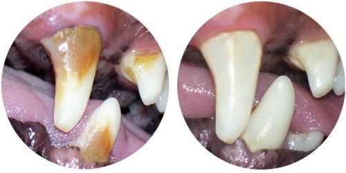 Удаление зубного камня - Что нужно знать