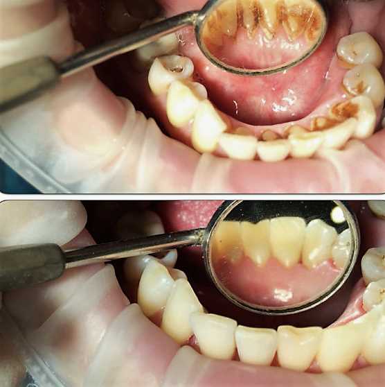 Виды чистки зубов и их особенности